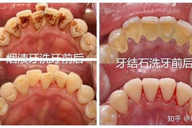 洗牙可以化解犯太岁