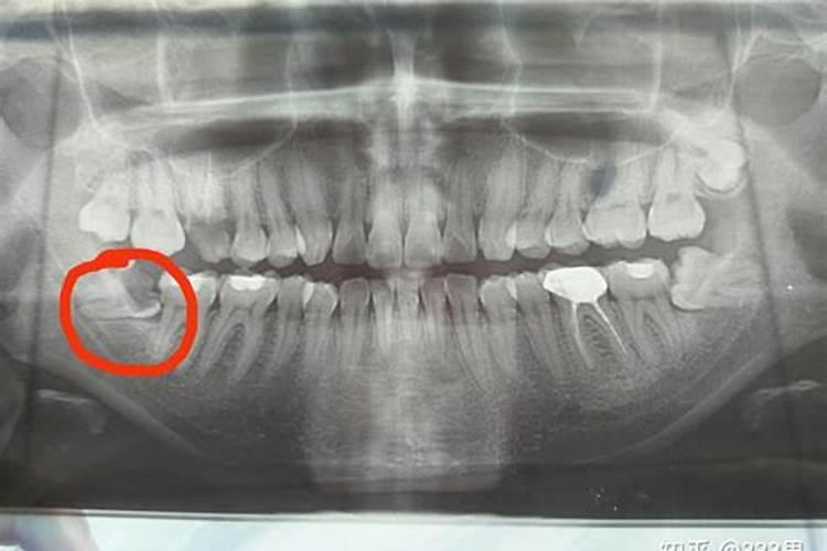 梦到牙齿被线缠住拔线把牙齿带掉了一半